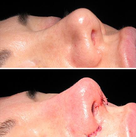 Rhinoplasty Before And After In Atlanta Georgia