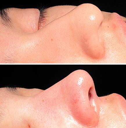 Before & After Rhinoplasty Surgery In Atlanta Georgia