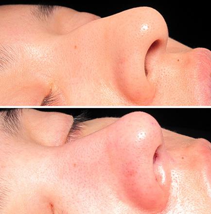 Before And After Rhinoplasty Surgery In Atlanta Georgia