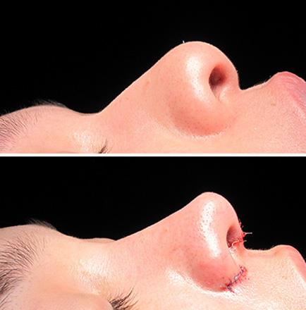 Rhinoplasty Surgery Before And After In Atlanta Georgia