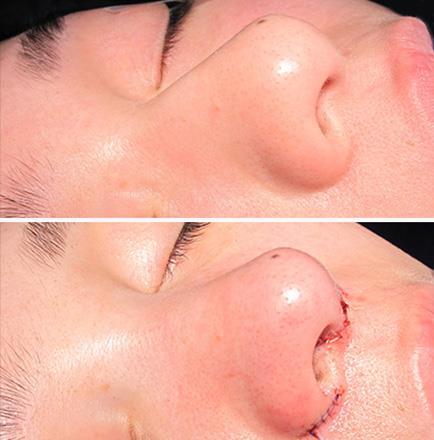Results Of Nose Surgery In Atlanta GeorgiaResults Of Nose Surgery In Atlanta Georgia