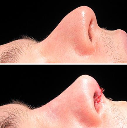 Before And After Nose Surgery In Atlanta Georgia