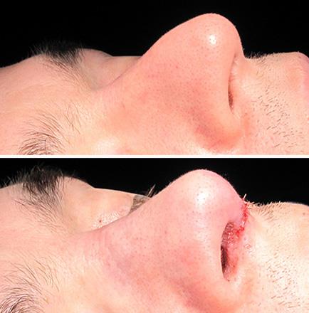 Nose Surgery Before And After In Atlanta Georgia