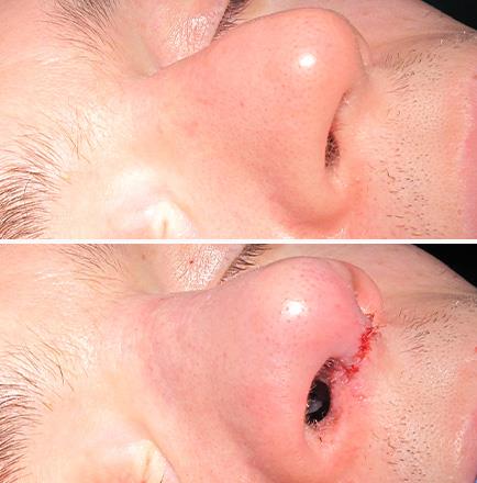 Before & After Nose Surgery In Atlanta Georgia