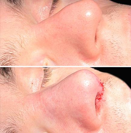 Nose Surgery Before & After In Atlanta Georgia