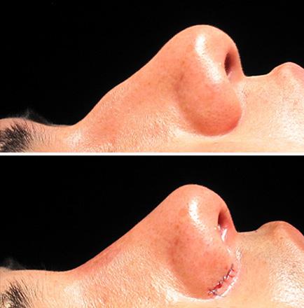 Rhinoplasty Results In Georgia