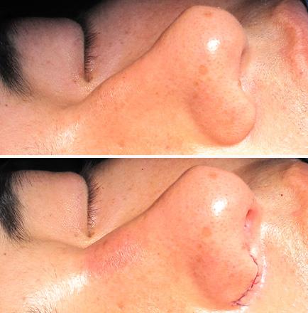 Results Of Rhinoplasty Surgery In Georgia