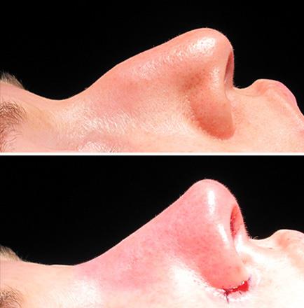 Before & After Rhinoplasty In Georgia