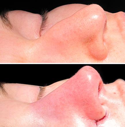 Rhinoplasty Before & After In Georgia