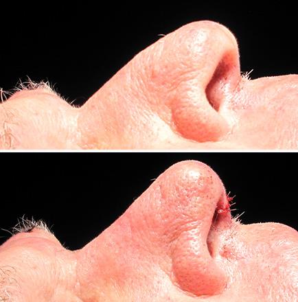 Before And After Rhinoplasty Surgery In Georgia