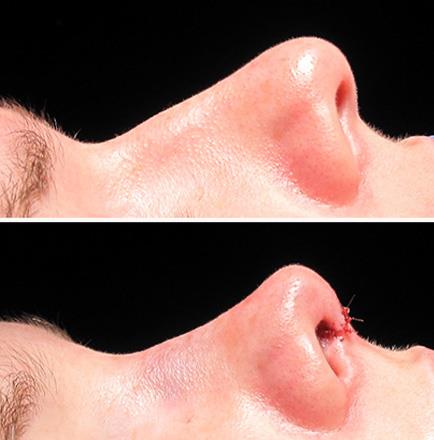 Nose Surgery Results In Georgia