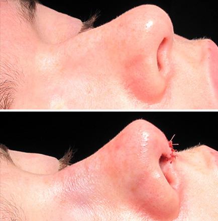 Before And After Nose Surgery In Georgia