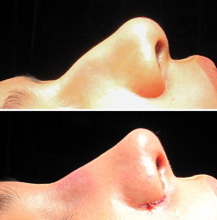 Nose Surgery Before And After In Georgia