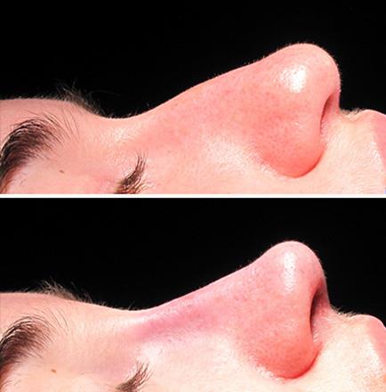 Rhinoplasty Results In GA