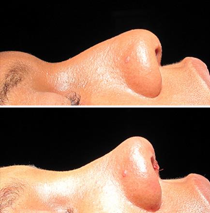 Before & After Rhinoplasty In GA