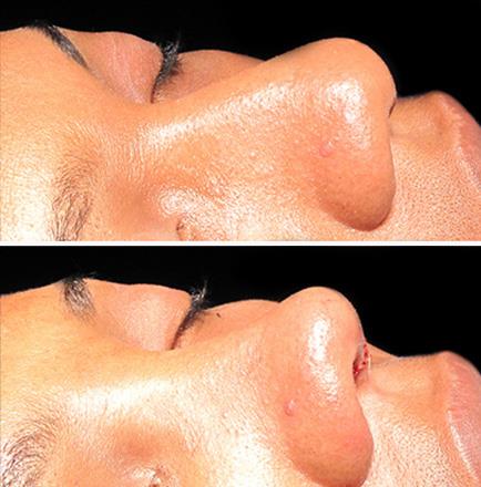 Rhinoplasty Before & After In GA