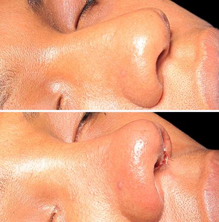 Rhinoplasty Before And After In GA