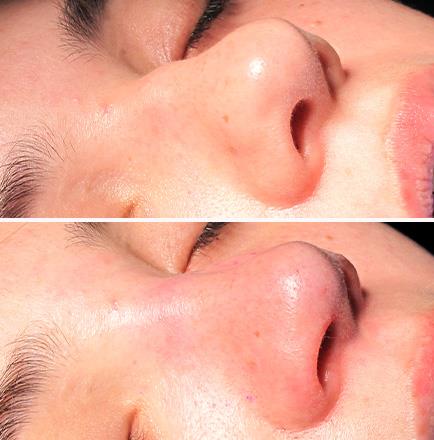 Before & After Rhinoplasty Surgery In GA