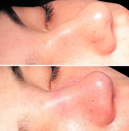 Rhinoplasty Surgery Before & After In GA