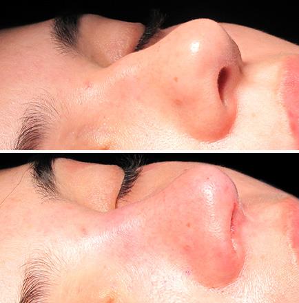 Rhinoplasty Surgery Before And After In GA