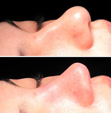 Scarless Rhinoplasty Surgery Before & After Atlanta