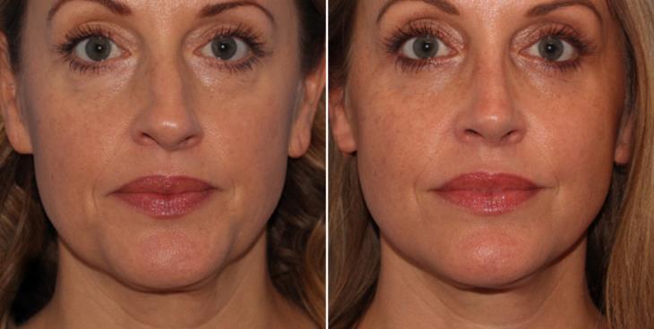 Neck Lift Results Marietta GA