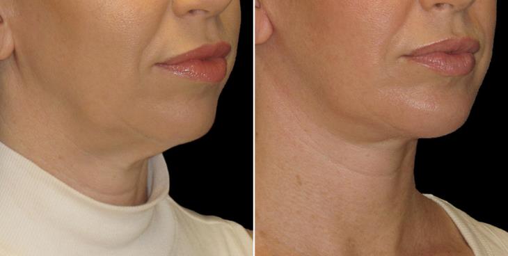 Neck Lift Surgery Before & After Marietta ¾ Right View