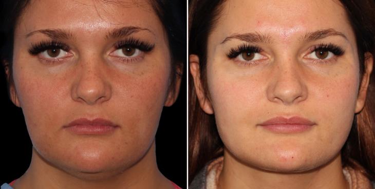 Injectables Front