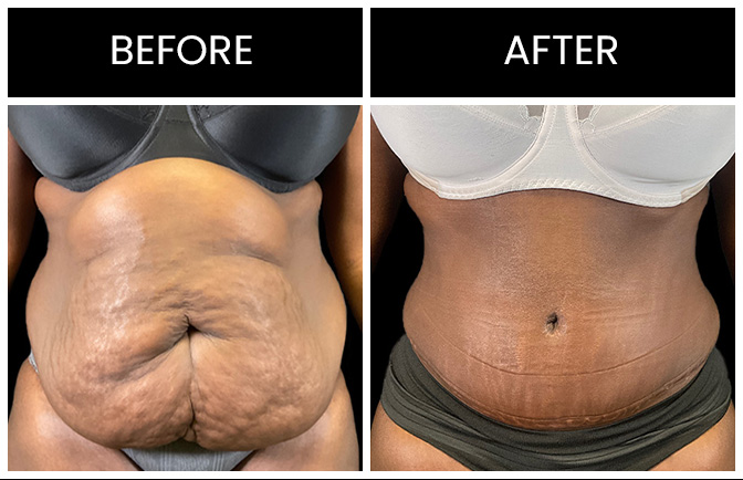 Lipo 360 Surgery Results In Atlanta