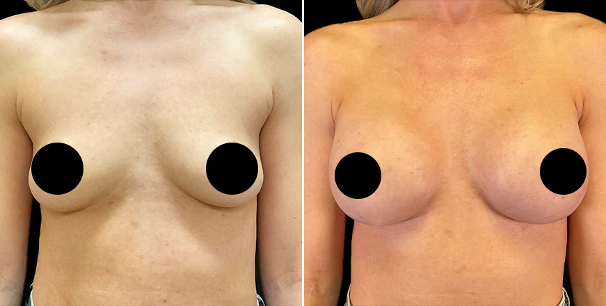 Breast Augmentation Surgery Results
