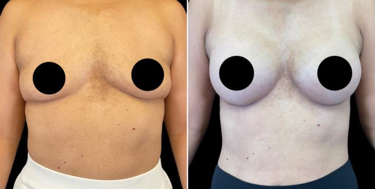 Breast Augmentation Surgery Results