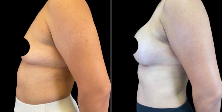 Breast Augmentation Surgery Results