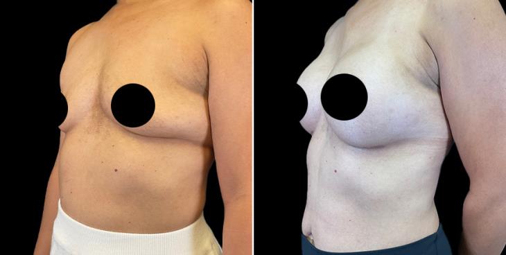 Breast Augmentation Surgery Results