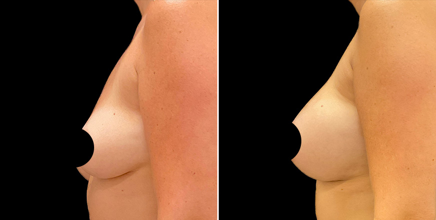 Breast Augmentation Surgery Results
