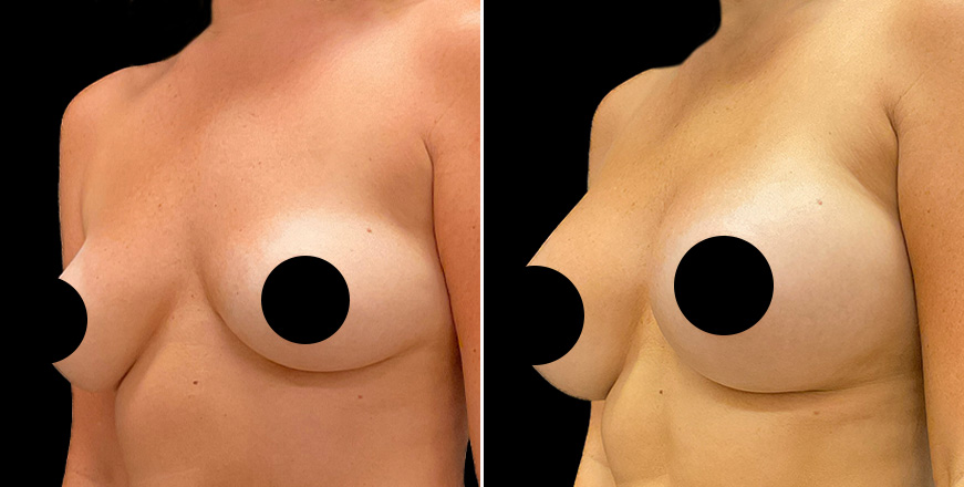 Breast Augmentation Surgery Results