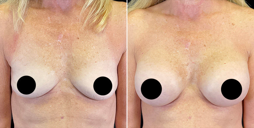 Breast Augmentation Surgery Results