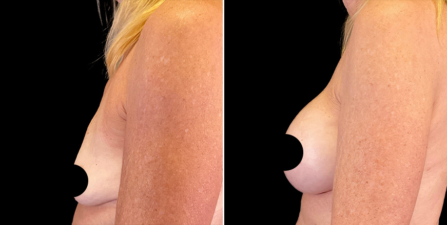 Breast Augmentation Surgery Results