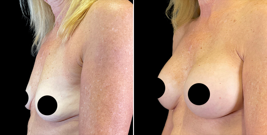 Breast Augmentation Surgery Results