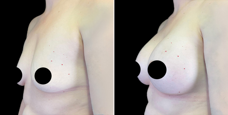 Breast Augmentation Surgery Results