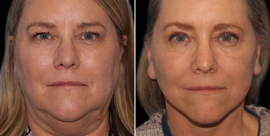 Plastic Surgery Results