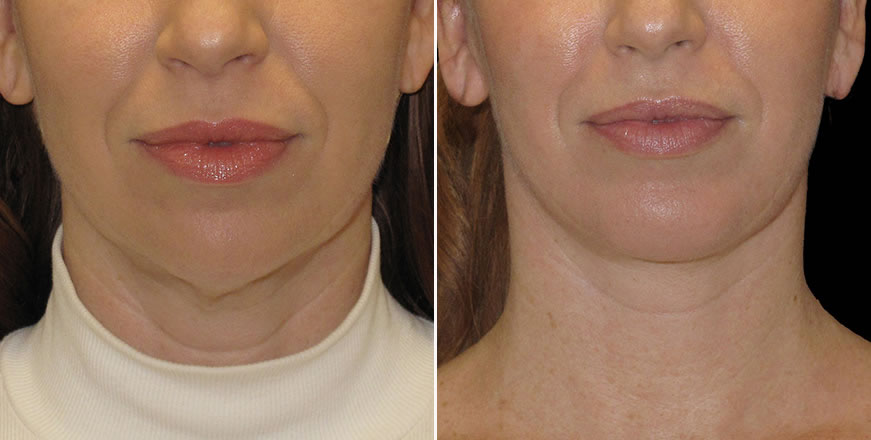 Plastic Surgery Results