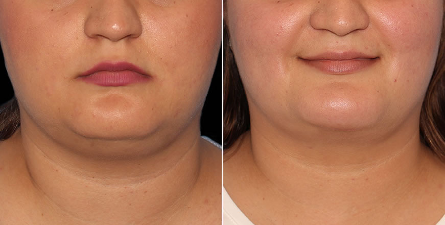 Plastic Surgery Results