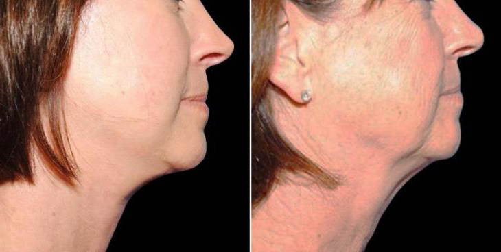 Plastic Surgery Results